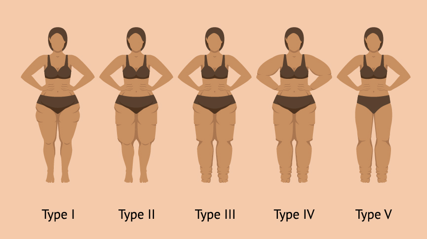 Fisioterapia Lipedema, Fisioterapia y Osteopatía Barón, Móstoles